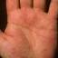 41. Eczema on the Palms Pictures