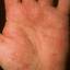 42. Eczema on the Palms Pictures