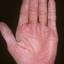 43. Eczema on the Palms Pictures