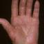 45. Eczema on the Palms Pictures