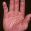 48. Eczema on the Palms Pictures