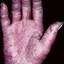 54. Eczema on the Palms Pictures