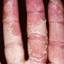 56. Eczema on the Palms Pictures