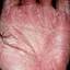 58. Eczema on the Palms Pictures