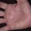 6. Eczema on the Palms Pictures