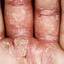 61. Eczema on the Palms Pictures
