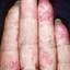 68. Eczema on the Palms Pictures