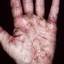 71. Eczema on the Palms Pictures