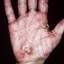 73. Eczema on the Palms Pictures
