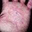 74. Eczema on the Palms Pictures