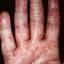 76. Eczema on the Palms Pictures