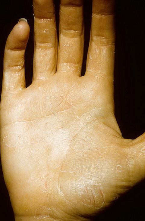Eczema On The Palms Pictures 224 Photos And Images