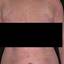 2. Eczema on the Stomach Pictures