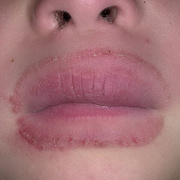Eczema on Lips