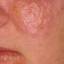 1. Eczema on Lips Pictures