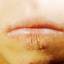 3. Eczema on Lips Pictures