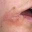 7. Eczema on Lips Pictures
