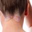 1. Eczema on Head Pictures