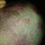 10. Eczema on Head Pictures