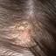 2. Eczema on Head Pictures