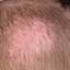 3. Eczema on Head Pictures