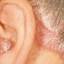 5. Eczema on Head Pictures