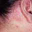 6. Eczema on Head Pictures