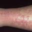1. Eczema on Shin Pictures