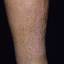 10. Eczema on Shin Pictures