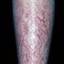 11. Eczema on Shin Pictures