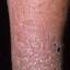 12. Eczema on Shin Pictures