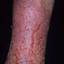 13. Eczema on Shin Pictures