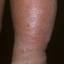 16. Eczema on Shin Pictures