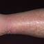 2. Eczema on Shin Pictures