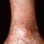 21. Eczema on Shin Pictures