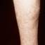 22. Eczema on Shin Pictures