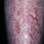 24. Eczema on Shin Pictures