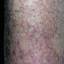 26. Eczema on Shin Pictures