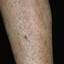 27. Eczema on Shin Pictures