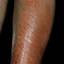28. Eczema on Shin Pictures