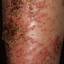 29. Eczema on Shin Pictures