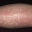 3. Eczema on Shin Pictures