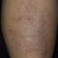 31. Eczema on Shin Pictures