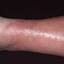 32. Eczema on Shin Pictures