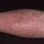 33. Eczema on Shin Pictures