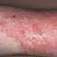 36. Eczema on Shin Pictures