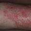 37. Eczema on Shin Pictures