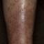 39. Eczema on Shin Pictures