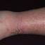 4. Eczema on Shin Pictures