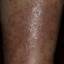 40. Eczema on Shin Pictures